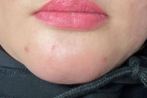 Trước và sau Tết Nguyên đán: Các ca bệnh biến chứng sau tiêm filler tăng mạnh