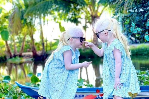 Cặp đôi song sinh mắc bệnh bạch tạng ở Sóc Trăng giờ ra sao?