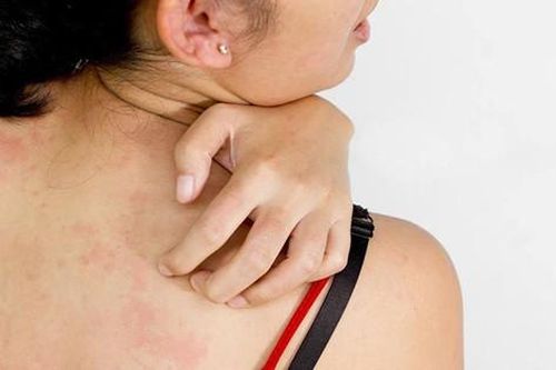 Người bị dị ứng thực phẩm có thêm thuốc điều trị mới