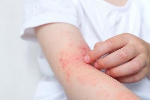 Những biến chứng của viêm da dị ứng