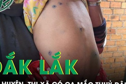 Đắk Lắk: 60 ca mắc thủy đậu tại 15 huyện, thị xã, thành phố