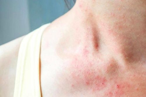 Những cách giúp hạn chế tác nhân gây viêm da dị ứng trong mùa lạnh