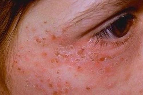 Cô gái 20 tuổi mắc bệnh 'ma cà rồng'