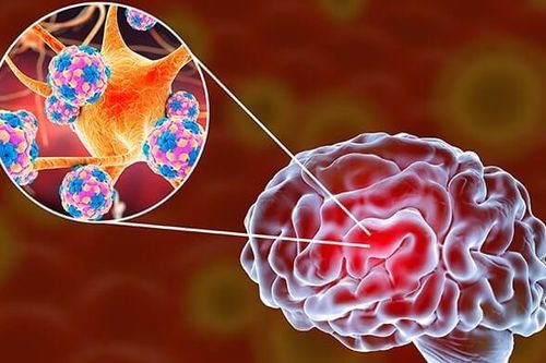 Lý do gây bệnh viêm não virus