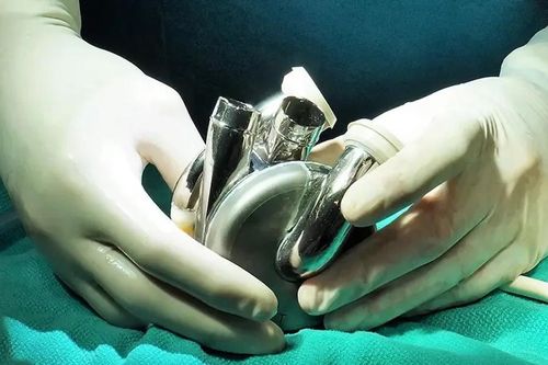 Phát triển đột phá công nghệ cấy ghép tim