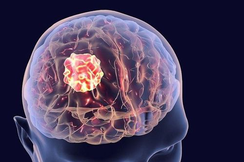 Bác sĩ trả lời: 72 tuổi, mổ u não có an toàn không?