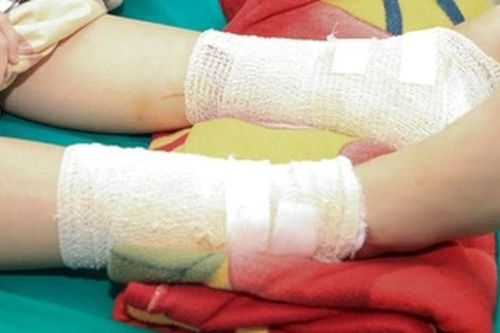 Bé gái bị bỏng nặng do nghịch cồn