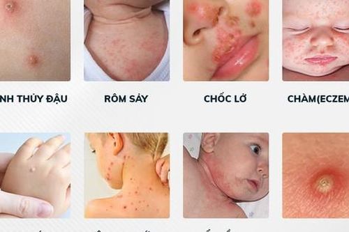 Mẩn đỏ, mụn li ti hay gặp ở trẻ sơ sinh chữa thế nào?