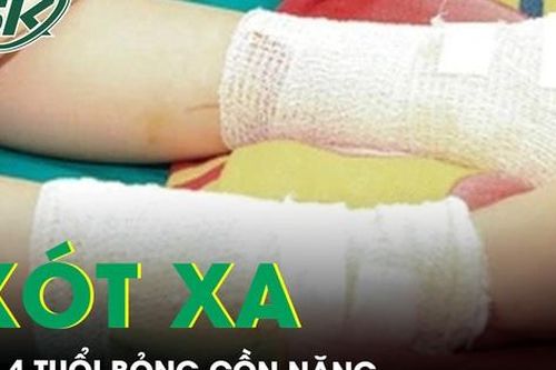 Xót xa bé gái 4 tuổi bỏng nặng do cồn