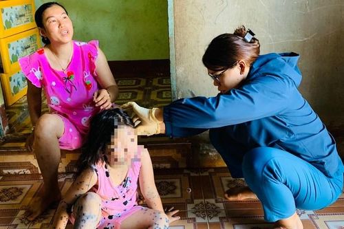 Đắk Lắk xuất hiện 3 ổ dịch thủy đậu tại 3 trường học