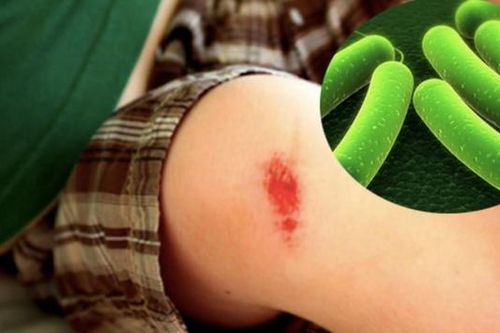 Cẩn trọng với uốn ván, căn bệnh có tỷ lệ tử vong cao