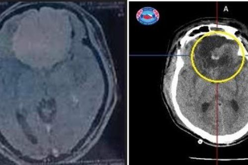 Đau đầu, chóng mặt vào viện phát hiện khối u màng não 'khổng lồ'