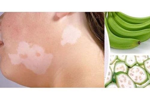 Thảo dược điều trị lang ben