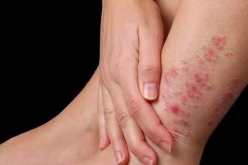 Viêm da cơ địa có nguy hiểm không?