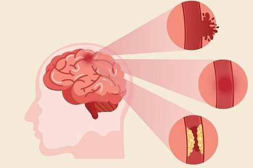 Bệnh nhân tai biến mạch máu não được Cảnh sát giao thông đưa đi cấp cứu kịp thời