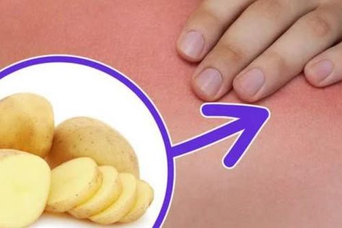 Khoai tây có tác dụng chữa bệnh gì?