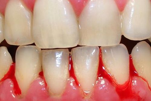 Bất ngờ với nguyên nhân gây viêm lợi nhiều người chưa biết
