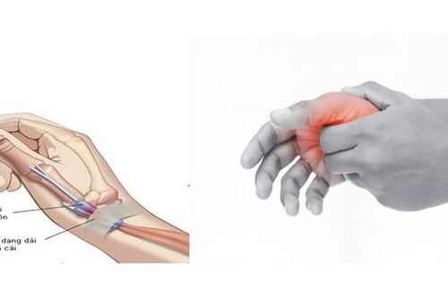 Đau cổ tay lan ra ngón cái là bệnh gì?