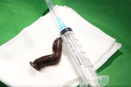Hà Nội: Đỉa dài 6cm trú ẩn trong cổ họng người đàn ông 53 tuổi