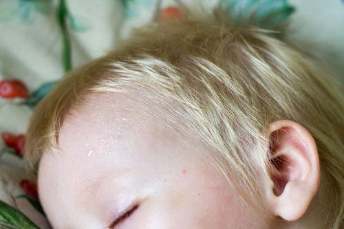 Bác sĩ trả lời: Trẻ nhỏ mồ hôi ra nhiều có dễ gây viêm phổi không?