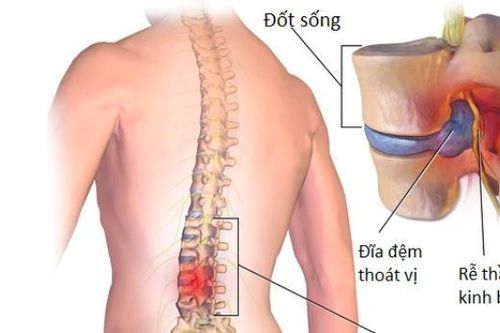 Bệnh viện đầu tiên có kỹ thuật mới giúp người mắc bệnh cột sống nhanh khỏi