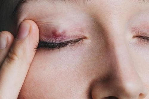 Nổi u trên mí mắt: Dấu hiệu ung thư hay bệnh lý khác?