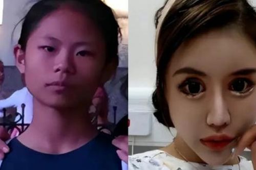 Cô gái nghiện làm đẹp từ năm 13 tuổi, chi 14 tỷ đồng để phẫu thuật thẩm mỹ, hiện tại hối hận nhưng đã muộn màng