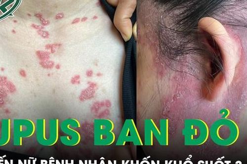 Nữ bệnh nhân khốn khổ 3 năm sưng đau khớp, tăng huyết áp, suy thận phải lọc máu chỉ vì Lupus ban đỏ