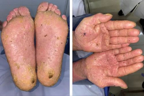 Dùng thuốc đông y không rõ nguồn gốc, nam bệnh nhân mắc ung thư do nhiễm thạch tín