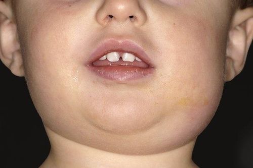 Nam giới có cần tiêm vaccine quai bị?