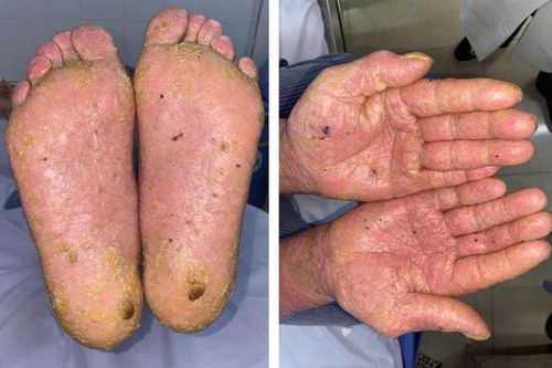 Người đàn ông nhiễm độc thạch tín từ thói quen sinh hoạt không ngờ