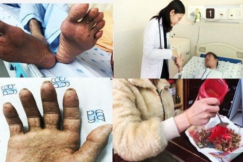 Liên tiếp các trường hợp nhiễm độc thạch tín do thói quen sinh hoạt hằng ngày