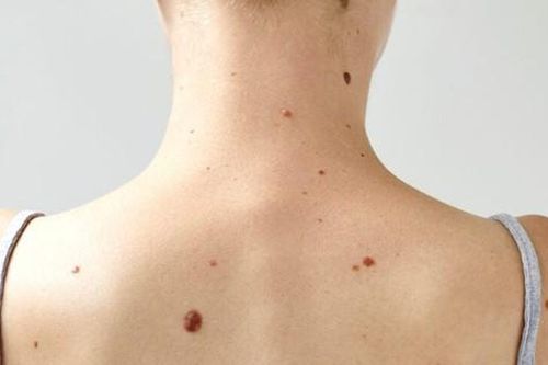 Làm thế nào để phân biệt đốm đồi mồi và ung thư da?