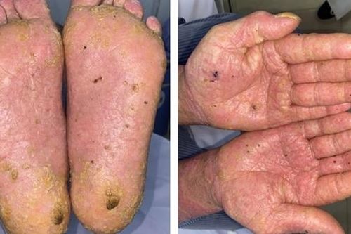 Uống thuốc đông y không rõ nguồn gốc, người đàn ông bị nhiễm độc asen nặng