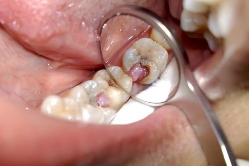 Chớ chủ quan với cơn đau răng