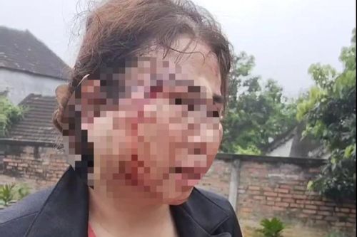 Công an vào cuộc vụ người vợ bị chồng bạo hành nhập viện trước ngày ly hôn