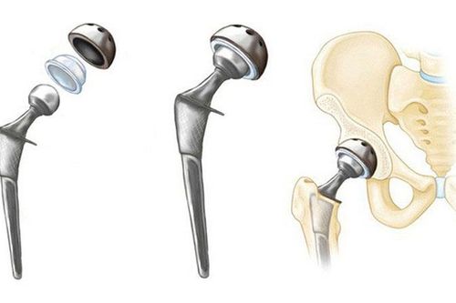 Bác sĩ trả lời: Bị hoại tử chỏm xương đùi độ 4 có cần thay khớp háng không?