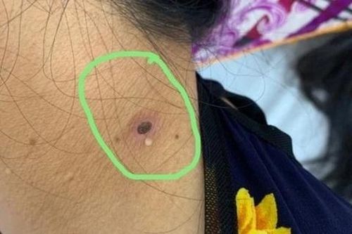 Dấu hiệu cảnh báo vết loét nguy hiểm