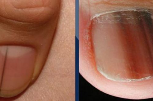 Móng tay xuất hiện sọc đen có phải là dấu hiệu cảnh báo ung thư?