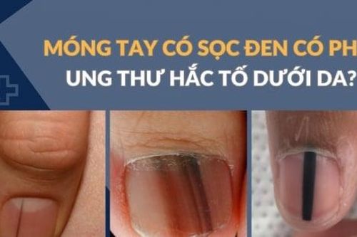 Sọc đen trên móng tay có phải dấu hiệu ung thư hắc tố da?