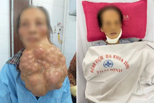 Người phụ nữ mang khối u 5kg trên mặt