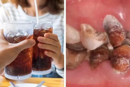 Uống nước ngọt hằng ngày, cô gái tốn hơn nửa tỷ thay răng