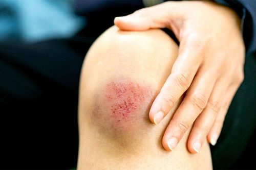 Bác sĩ trả lời: Ngã xe, sưng đầu gối có ảnh hưởng gì không?