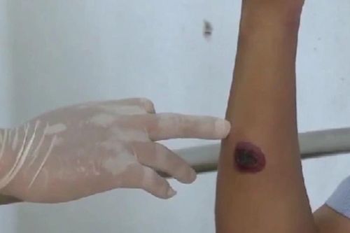 Lào phát hiện 3 người nhiễm bệnh than