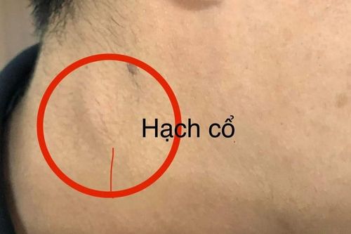 Nuốt nghẹn kéo dài, người đàn ông bất ngờ phát hiện mắc ung thư