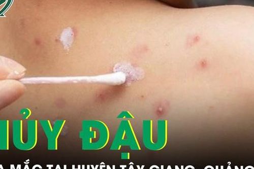Quảng Nam ghi nhận 11 ca mắc thủy đậu tại huyện Tây Giang