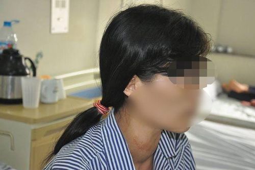 Nguy kịch tính mạng do điều trị basedow sai cách