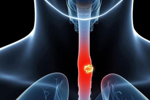 Người đàn ông nuốt nghẹn, nổi hạch cổ, đi khám phát hiện ung thư