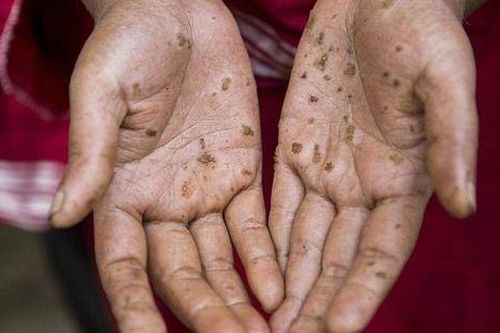 Bệnh nhân bị ung thư da do nhiễm độc Asen: Nguy cơ từ thuốc không nguồn gốc và nước giếng khoan