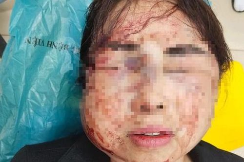 Người phụ nữ bị chồng bạo hành trước ngày ly hôn:Chồng tôi mắc 'bệnh' cuồng ghen